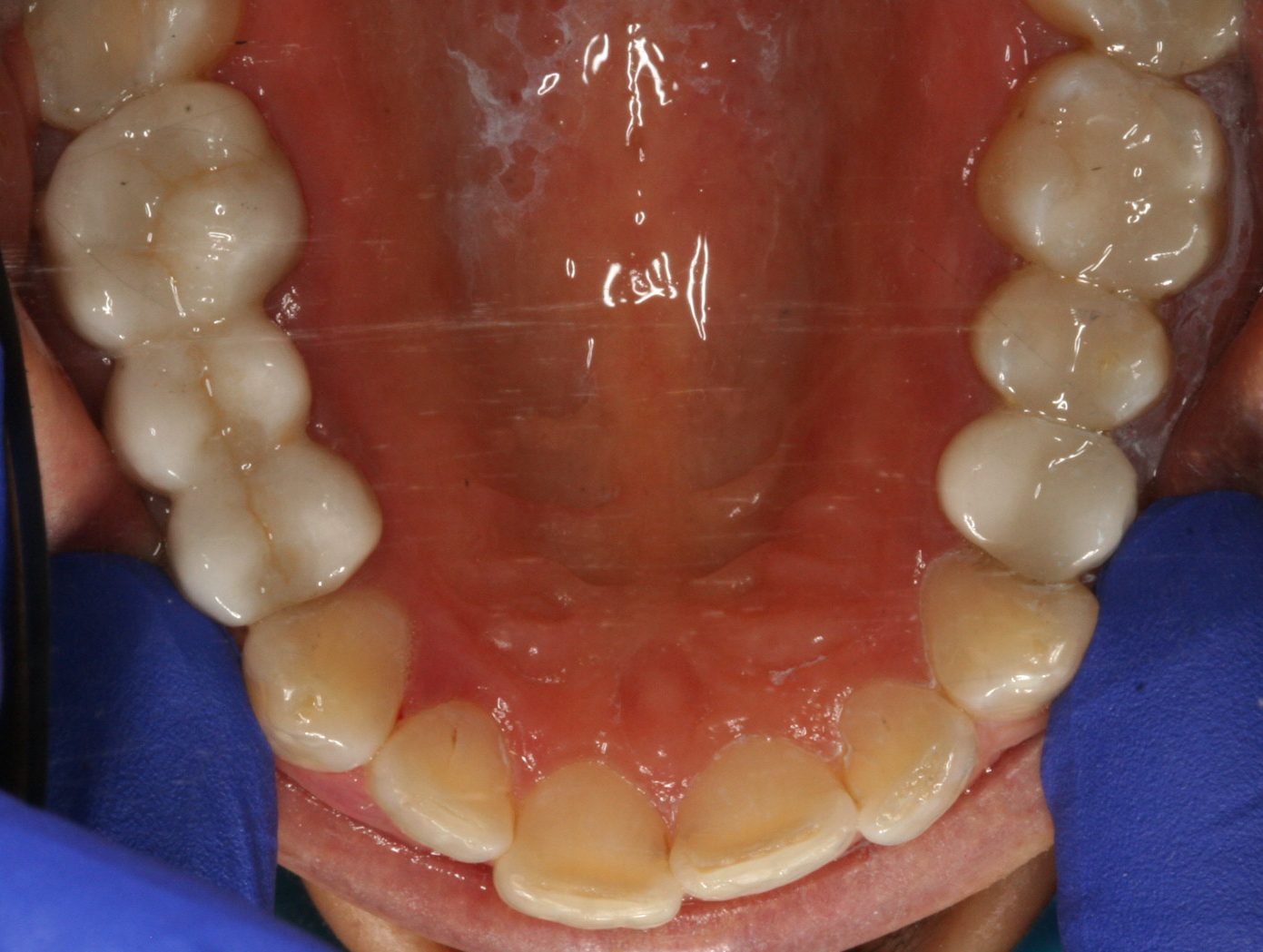 white fillings after essendon