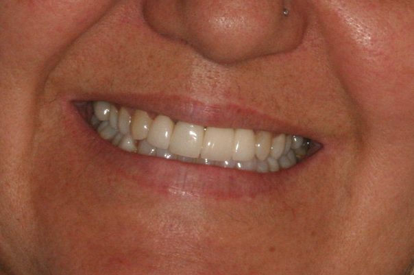 dental implants and crowns after