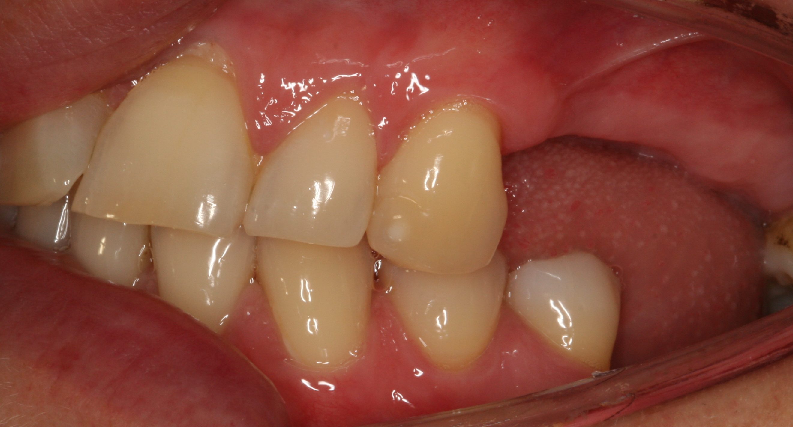 missing teeth before