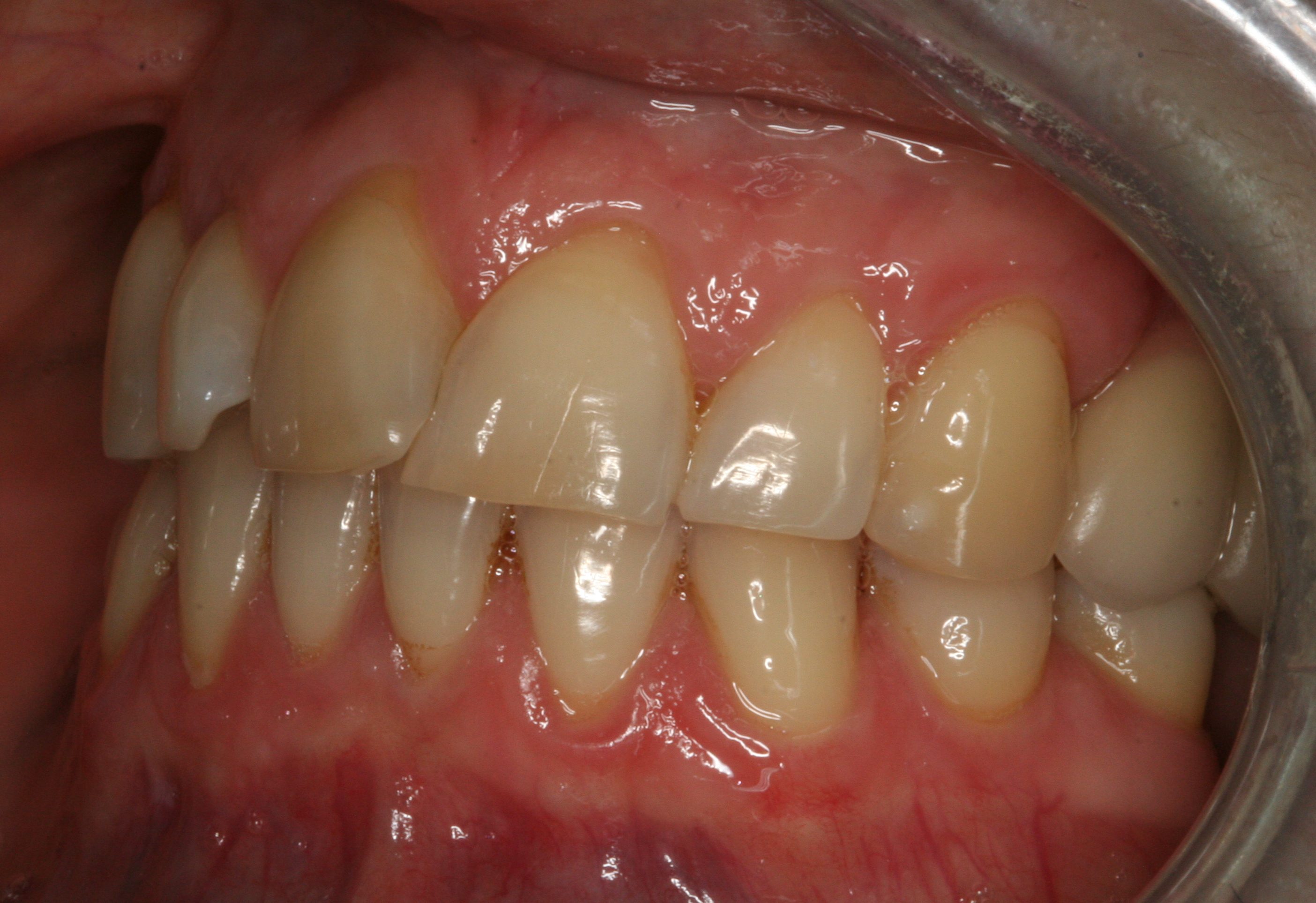 missing teeth fixed side view implants