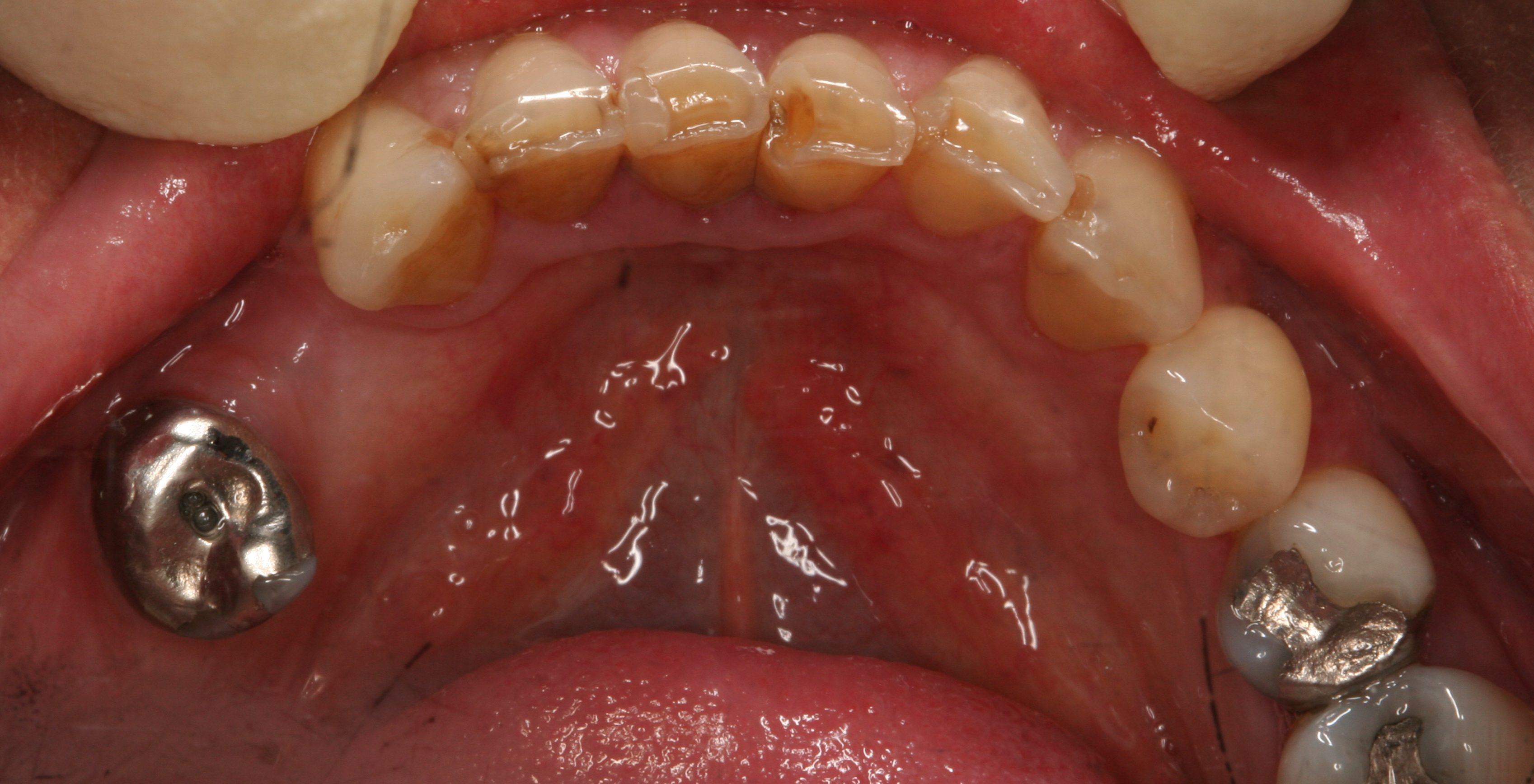 implant bridge