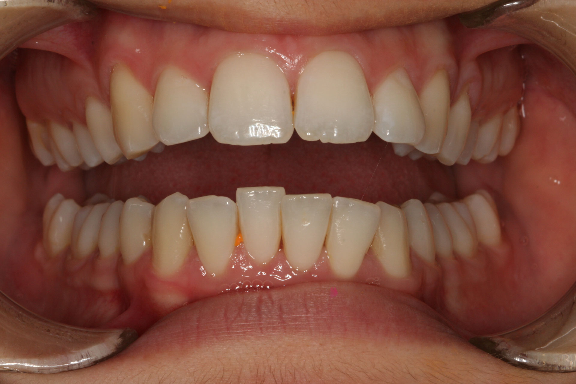Invisalign Before Essendon Patient 1