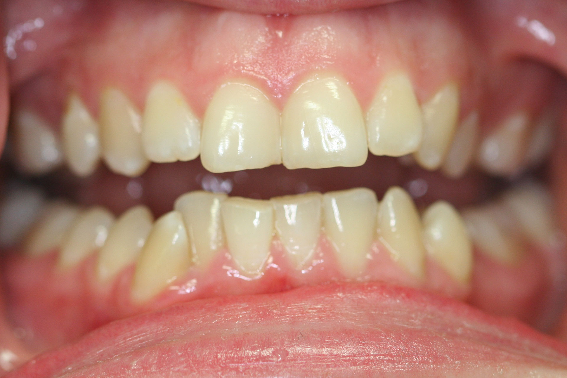 Invisalign Before Essendon Patient 2