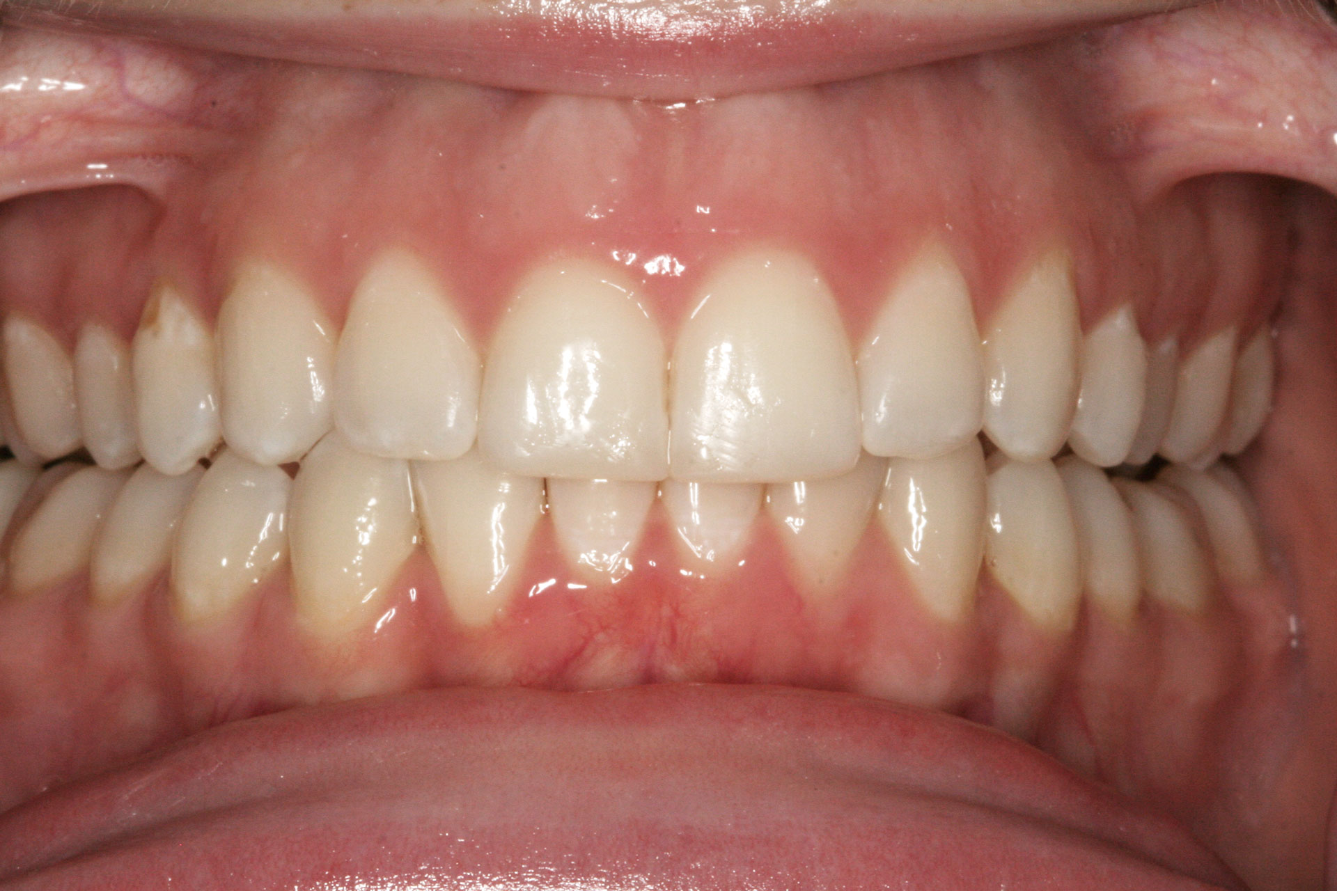 Invisalign After Essendon Patient 2