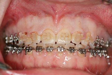Gum Surgery Case 1a Too much gum Before