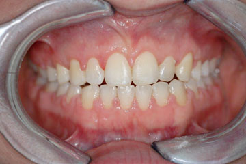 Gum Surgery Case 1b Too much gum Post
