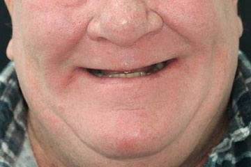 smile makeover options Melbourne dental implants implant-supported dentures before smile makeover options Melbourne dental implants implant-supported dentures before