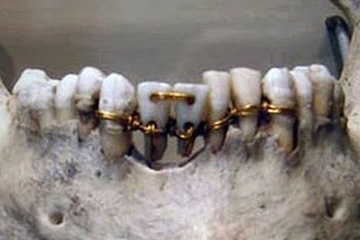 Ancient Egyptian dental bridge using donar teeth and gold wire c 2000 BC