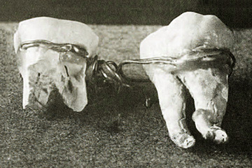 Ancient Egyptian dental bridge using gold wire ‘Giza bridge’ c 2500 BC Roemer- und Pelizaeus-Museum, Hildesheim