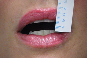 Locked jaw lockjaw temporomandibular joint (TMJ) dental trismus case study 01 before treatment Melbourne dentist Essendon Locked jaw lockjaw temporomandibular joint (TMJ) dental trismus case study 01 before treatment Melbourne dentist Essendon
