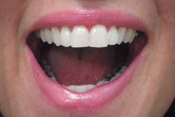 Locked jaw lockjaw temporomandibular joint (TMJ) dental trismus case study 03 2 weeks after treatment Melbourne dentist Essendon Locked jaw lockjaw temporomandibular joint (TMJ) dental trismus case study 03 2 weeks after treatment Melbourne dentist Essendon