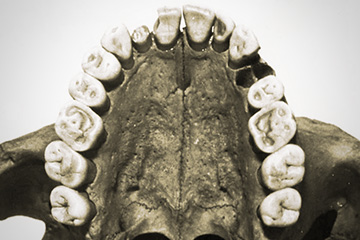 TMJ dysfunction tooth wear observed ancient Egyptian upper jaw
