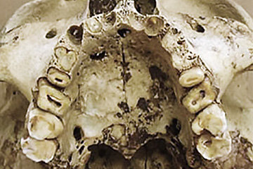 Tooth wear evidence TMJ dysfunction pulpal exposure ancient Egyptian teeth c-1500 BC