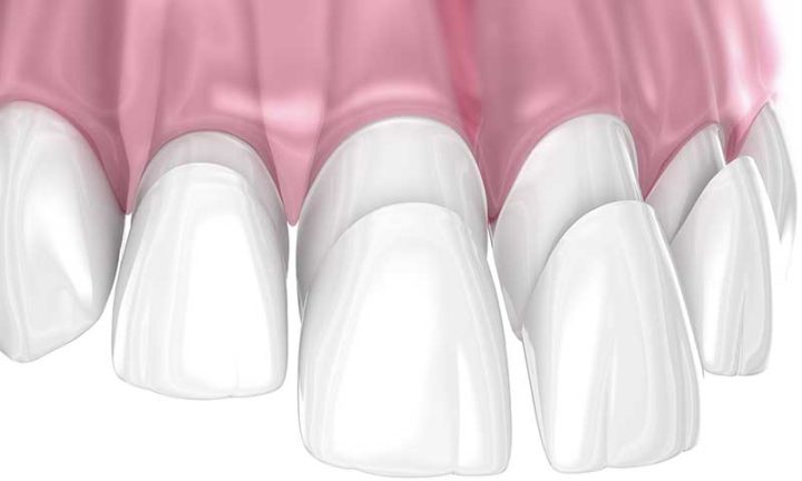 what are porcelain veneers 3D example Essendon dental clinic Melbourne