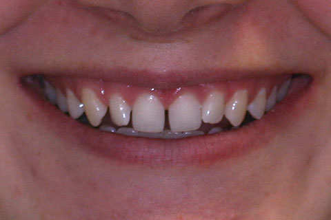 Porcelain Veneers Essendon Patient Melbourne Case Study Before