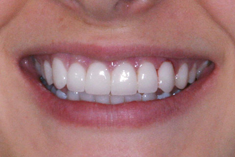 Porcelain Veneers Essendon Patient Melbourne Case Study After