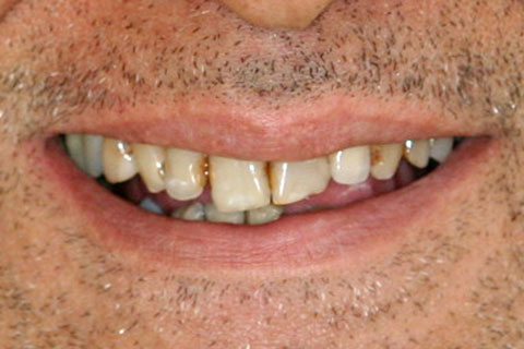 Porcelain Veneers Essendon Patient Melbourne Case Study Before
