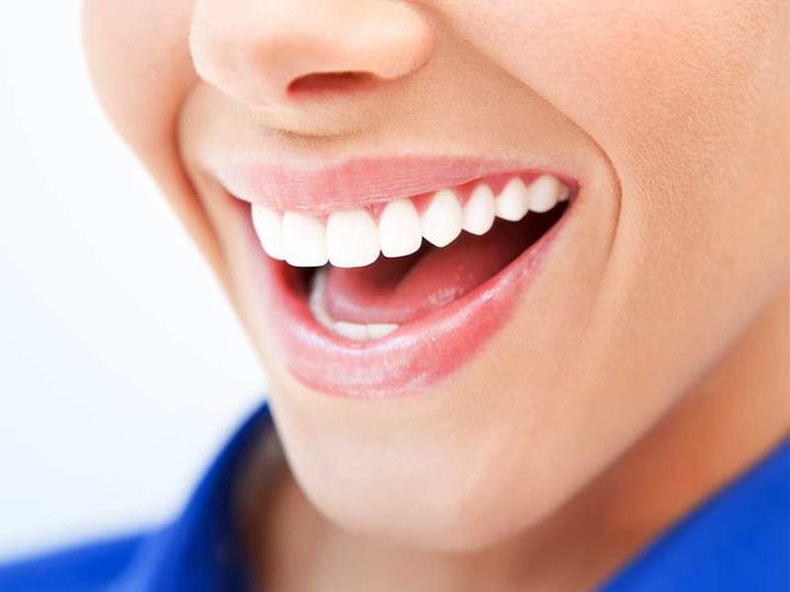 porcelain veneers Essendon dental clinic Melbourne perfect smile