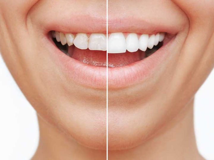 porcelain veneers benefits Essendon dental clinic Melbourne perfect smile before after example