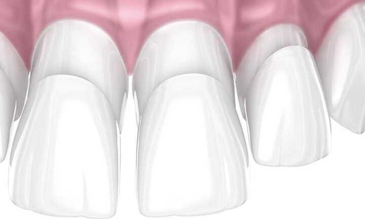 what are composite veneers resin dental bonding 3D example Melbourne dental clinic Essendon